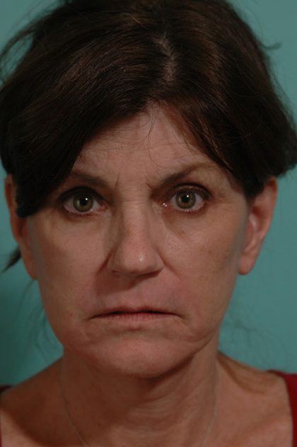 Facelift Before & After Patient #15283