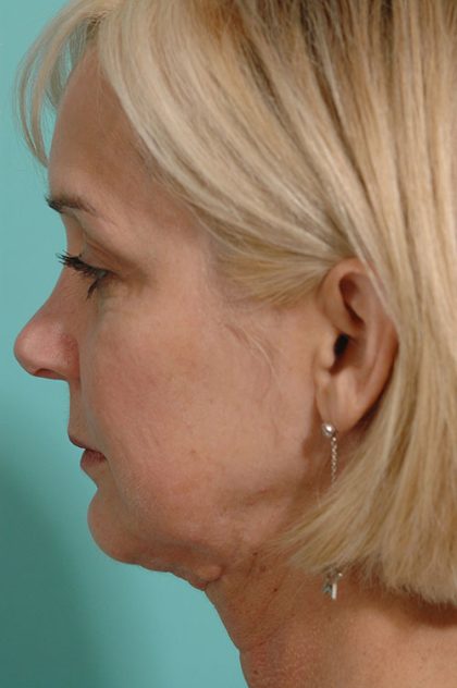 Necklift Before & After Patient #15284