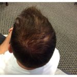 Scalp Hair Transplant Before & After Patient #15375