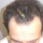 Scalp Hair Transplant Before & After Patient #15374