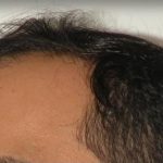 Scalp Hair Transplant Before & After Patient #15377