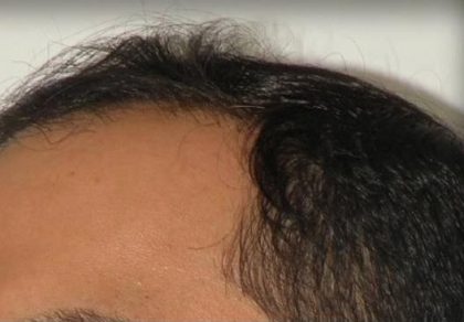Scalp Hair Transplant Before & After Patient #15377