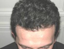 Scalp Hair Transplant Before & After Patient #15374