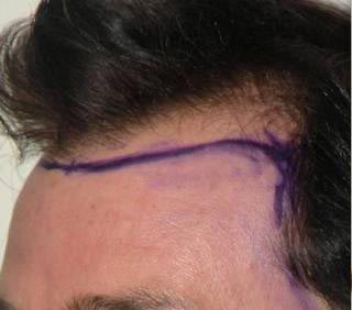 Scalp Hair Transplant Before & After Patient #15376
