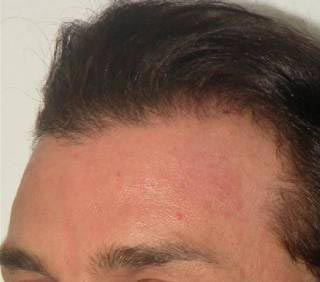 Scalp Hair Transplant Before & After Patient #15376