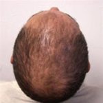 Scalp Hair Transplant Before & After Patient #15379
