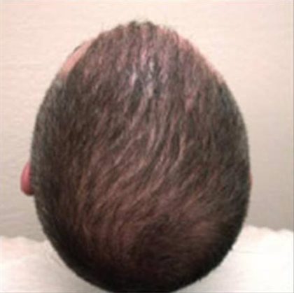 Scalp Hair Transplant Before & After Patient #15379