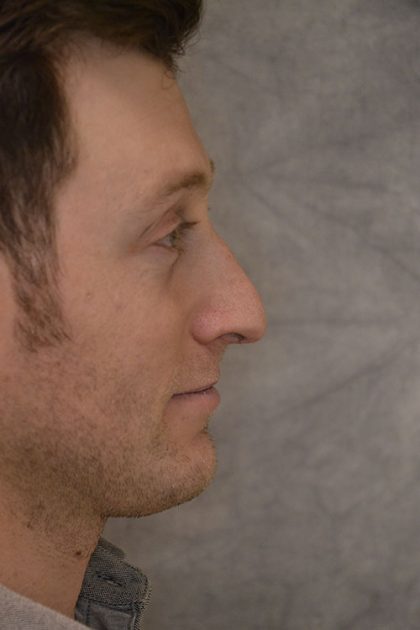 Rhinoplasty Before & After Patient #15467