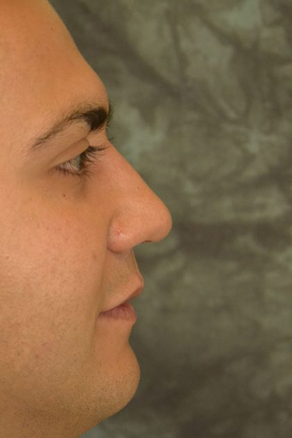 Rhinoplasty Before & After Patient #15464
