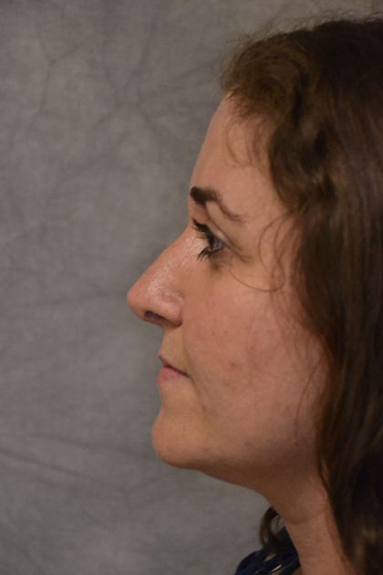 Rhinoplasty Before & After Patient #15461