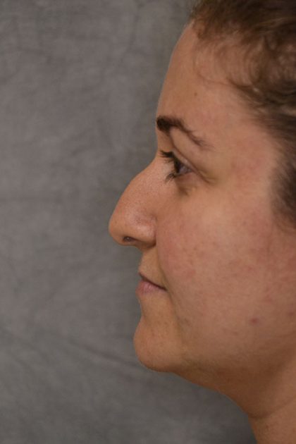 Rhinoplasty Before & After Patient #15461