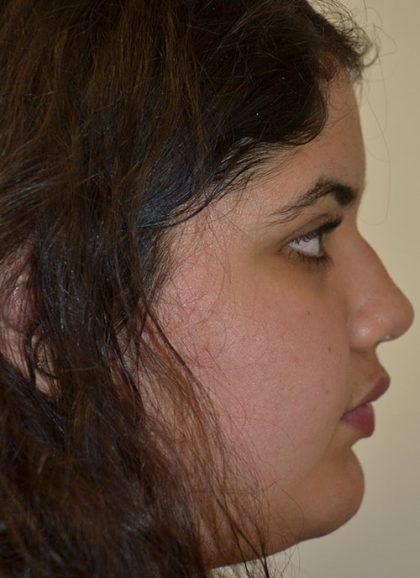 Rhinoplasty Before & After Patient #15462