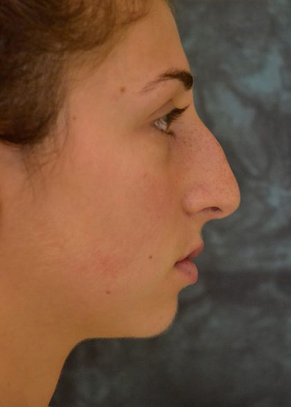 Rhinoplasty Before & After Patient #15465