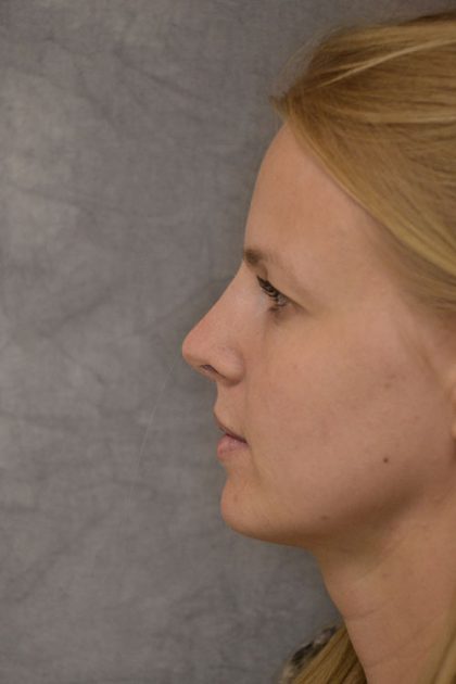 Rhinoplasty Before & After Patient #15471