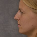 Rhinoplasty Before & After Patient #15471