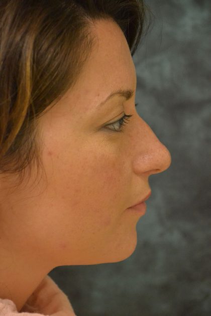 Rhinoplasty Before & After Patient #15468
