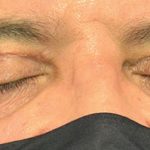 Blepharoplasty - Lower Lid Before & After Patient #15251