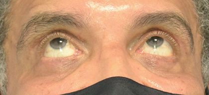 Blepharoplasty - Lower Lid Before & After Patient #15251