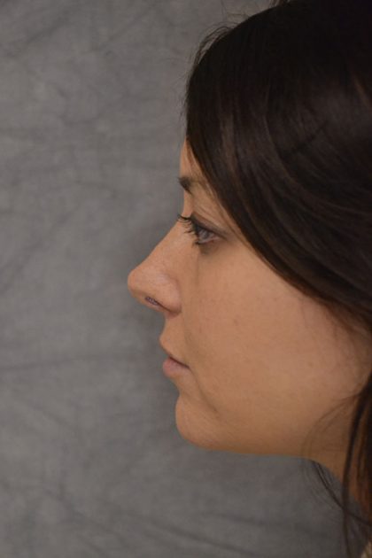 Rhinoplasty Before & After Patient #15468