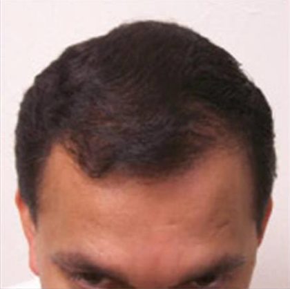 Scalp Hair Transplant Before & After Patient #15378