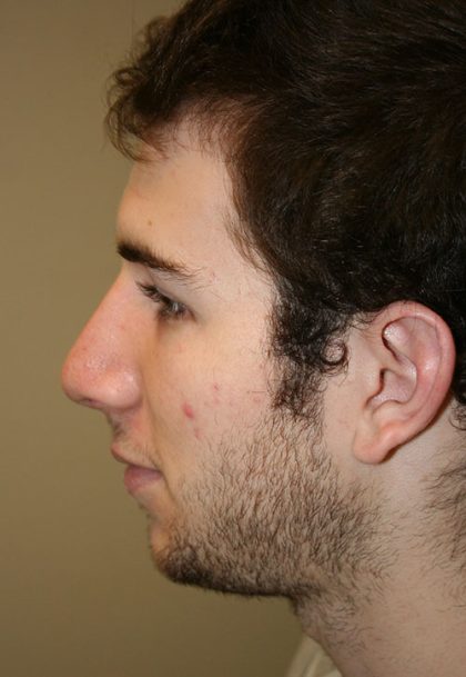 Rhinoplasty Before & After Patient #15466
