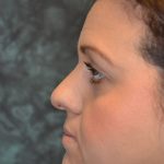 Rhinoplasty Before & After Patient #15463