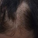PRP Hair Restoration Before & After Patient #15361