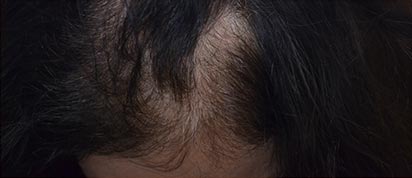 PRP Hair Restoration Before & After Patient #15361