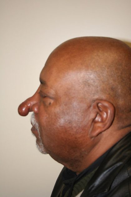 Rhinophyma Before & After Patient #15571