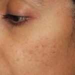 Acne & Acne Scarring Before & After Patient #16143