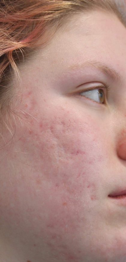 Acne & Acne Scarring Before & After Patient #16531