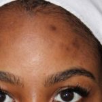 Acne & Acne Scarring Before & After Patient #16537