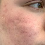 Acne & Acne Scarring Before & After Patient #16543