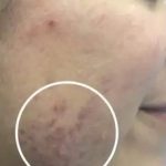 Acne & Acne Scarring Before & After Patient #16149