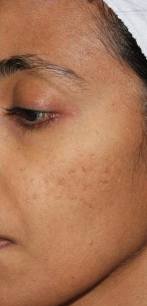 Acne & Acne Scarring Before & After Patient #16143