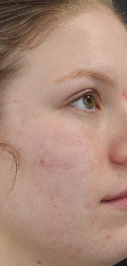 Acne & Acne Scarring Before & After Patient #16531