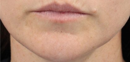 Acne & Acne Scarring Before & After Patient #16534