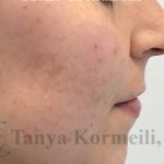 Acne & Acne Scarring Before & After Patient #16540
