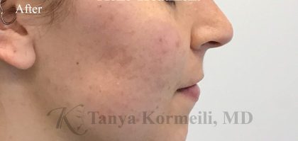 Acne & Acne Scarring Before & After Patient #16540