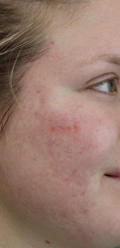 Acne & Acne Scarring Before & After Patient #16543