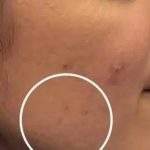 Acne & Acne Scarring Before & After Patient #16149