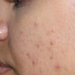 Acne & Acne Scarring Before & After Patient #16146