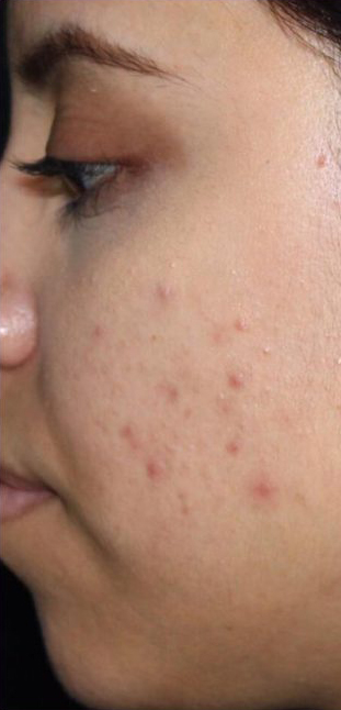 Acne & Acne Scarring Before & After Patient #16146
