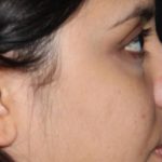 Acne & Acne Scarring Before & After Patient #16147
