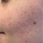 Acne & Acne Scarring Before & After Patient #16148