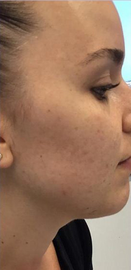 Acne & Acne Scarring Before & After Patient #16152