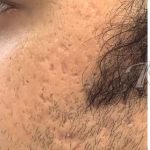 Acne & Acne Scarring Before & After Patient #16158