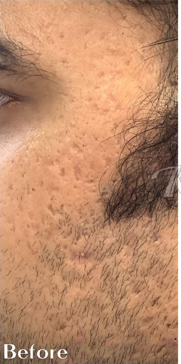 Acne & Acne Scarring Before & After Patient #16158