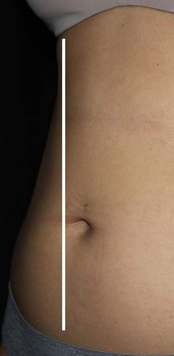 Body Contouring Before & After Patient #16396