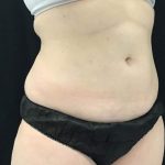 Body Contouring Before & After Patient #16397